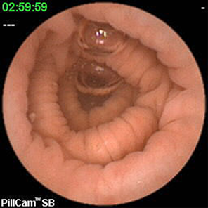 nuova_videocapsula_intelligente_per_il_colon.jpg